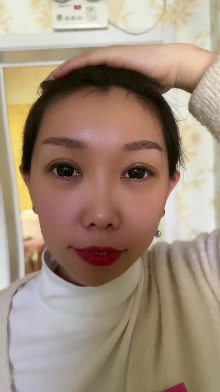 全切双眼皮一周拆线，恢复非常好，做的非常成功