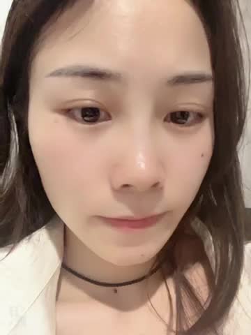 术后|保妥适瘦脸+下颌缘，效果到底怎么样？
