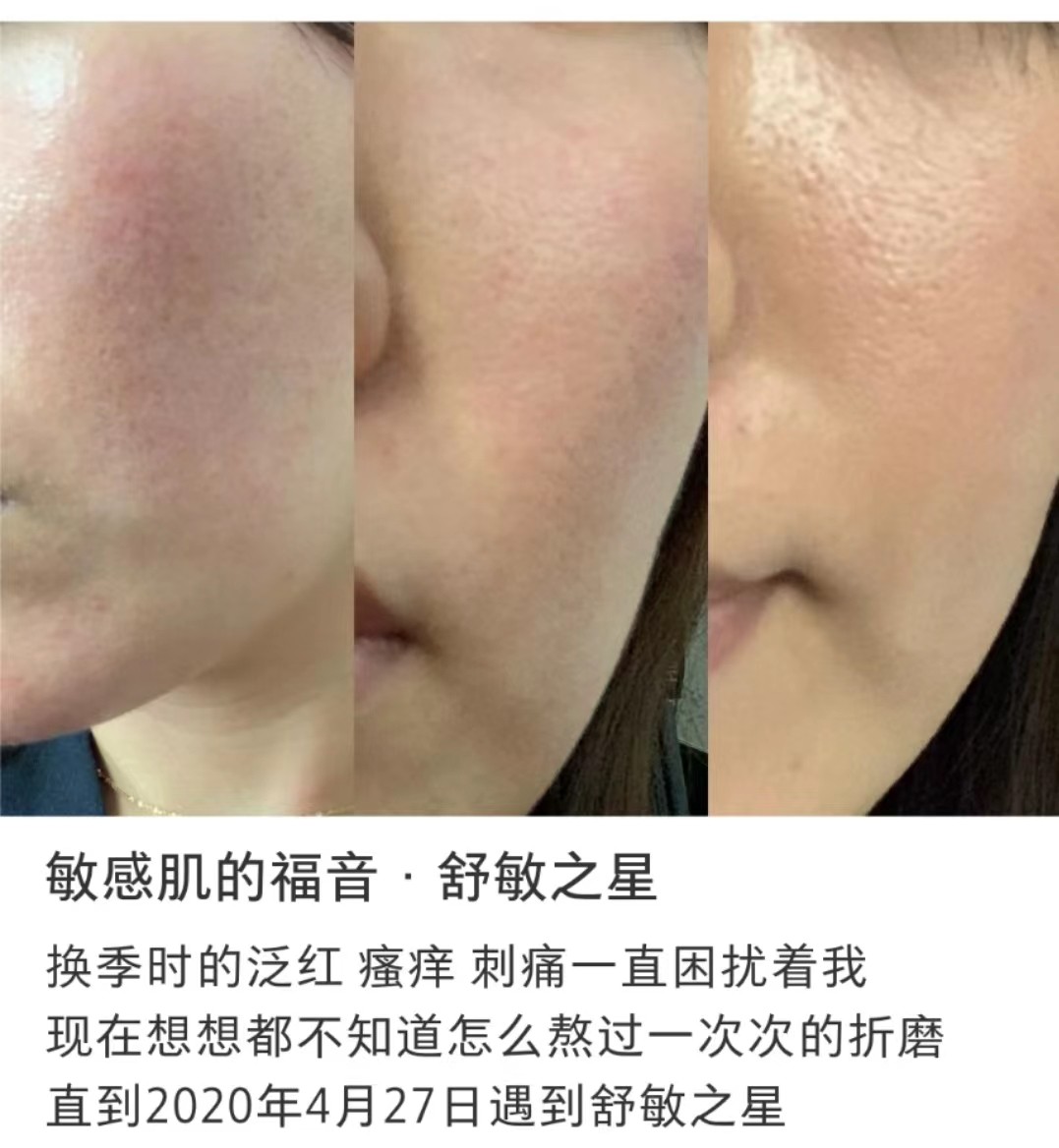 成都9月14日最划算的医美项目:680元尽享舒敏之星抗炎修复3次,敏感肌的换季福音-伴你美